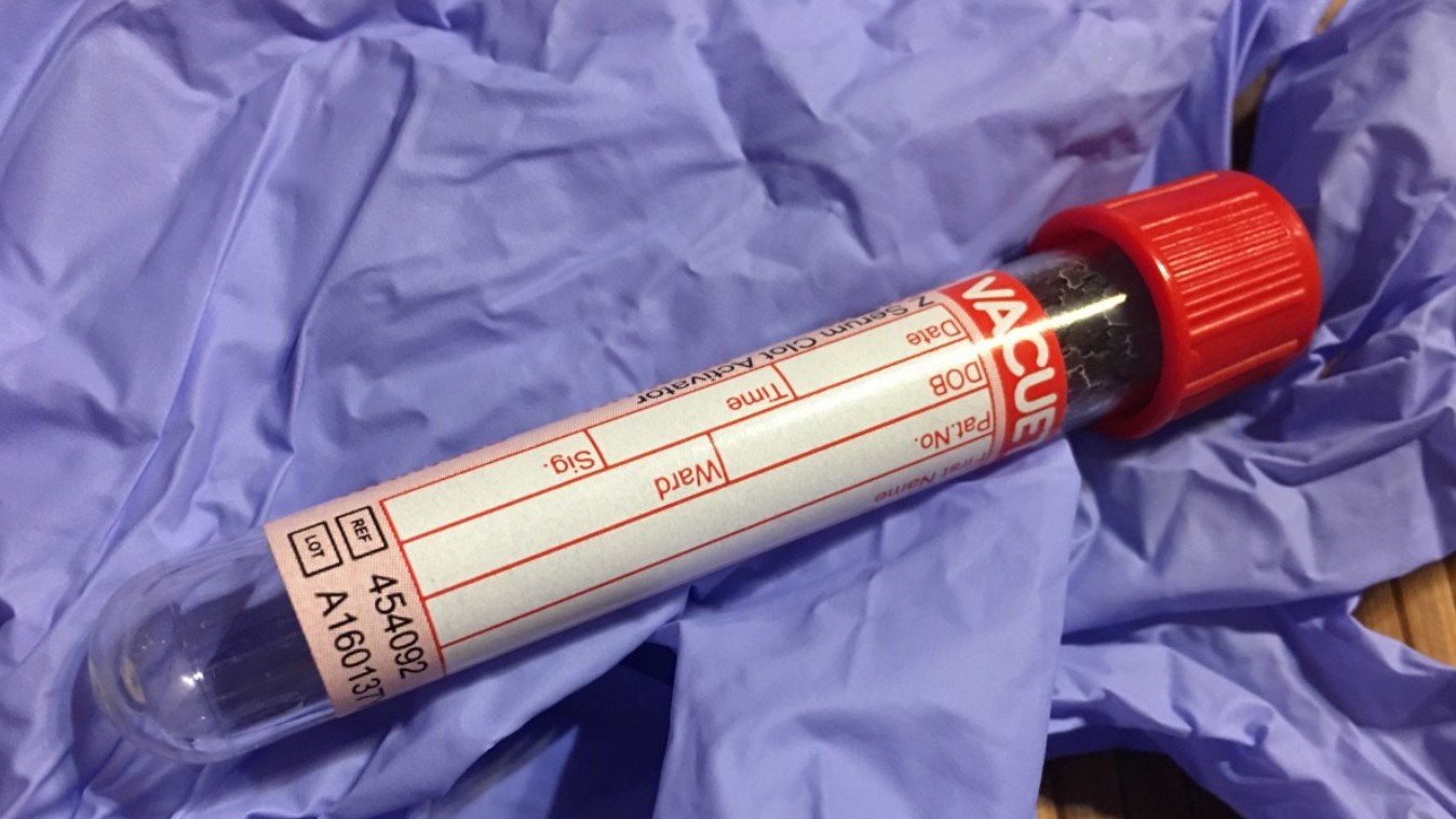 Австралийские учёные создали тест слюны для раннего выявления сердечной недостаточности