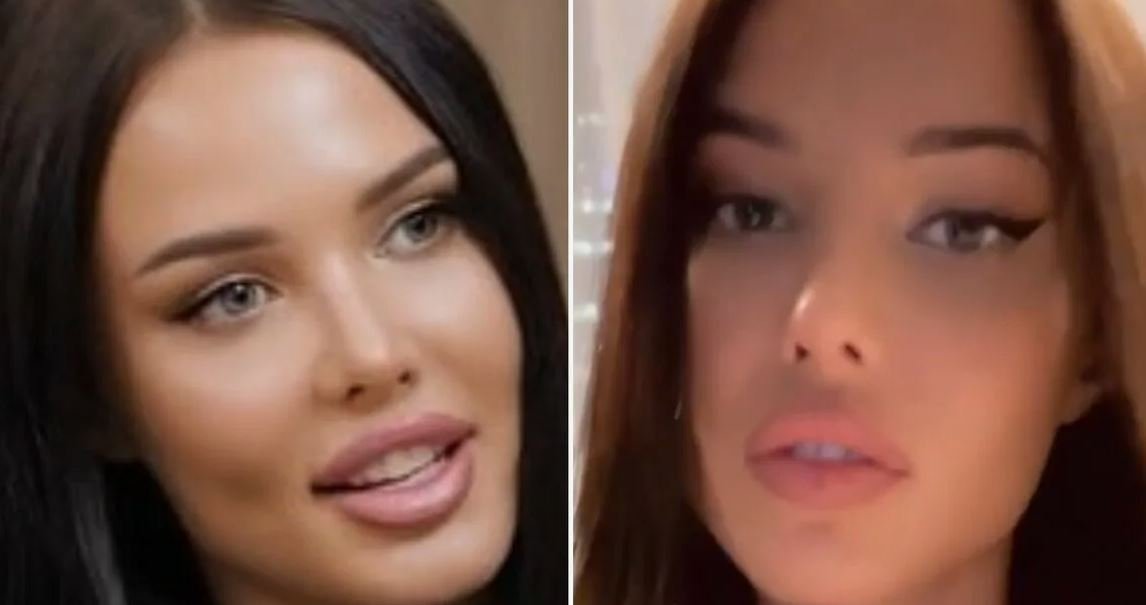 Анастасия Решетова продемонстрировала результат удаления филлера из губ